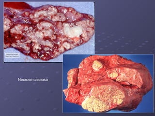 Necrose caseosa 