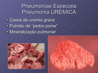 Pneumonias Especiais Pneumonia UREMICA Casos de uremia grave Pulmão de “pedra pome” Mineralização pulmonar  