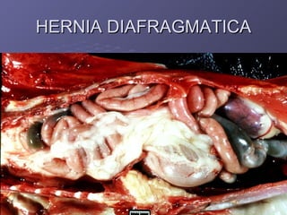 HERNIA DIAFRAGMATICA 