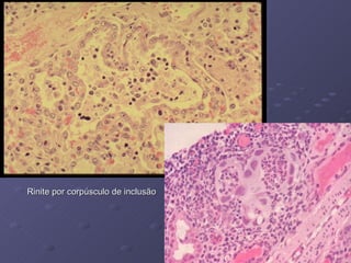 RINITE VIRAL DOS SUÍNOS imagem Rinite por corpúsculo de inclusão 