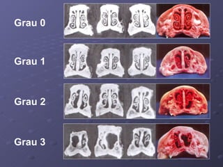 Grau 0 Grau 1 Grau 2 Grau 3 