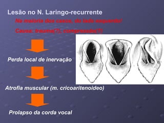 Lesão no N. Laringo-recurrente Perda local de inervação Atrofia muscular (m. cricoaritenoideo) Prolapso da corda vocal Na maioria dos casos, do lado esquerdo! Causa: trauma(?), compressão(?) 