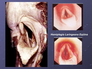 Hemiplegia Laringeana Eqüina 