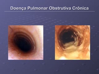 Doença Pulmonar Obstrutiva Crônica 