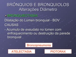 BRONQUIECTASIA Dilatação do Lúmen bronquial - BOV CAUSAS  - Acumulo de exsudato no lúmen com enfraquecimento ou destruição da parede bronquial BRÔNQUIOS E BRONQUIOLOS Alterações Diâmetro ATELECTASIA PIOTORAX Broncopneumonia 