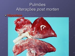 Pulmões Alterações  post morten Hipostase 
