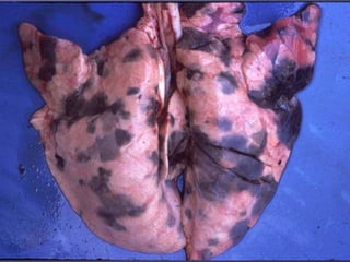 Pulmões  Pigmentação Anormal MELANOSE  – Acumulo de pigmento endogeno “tabuleiro de xadrez”  