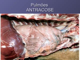 Pulmões  ANTRACOSE ANTRACOSE  – Particulas de carvão - Pigmento endogeno  - Grandes áreas urbanas  - Envolvimento dos linfonodos 