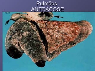 Pulmões  ANTRACOSE 