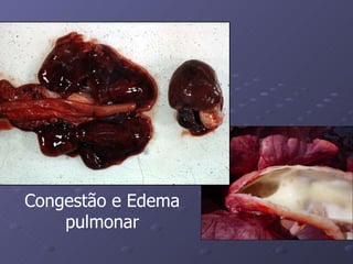 Congestão e Edema pulmonar 
