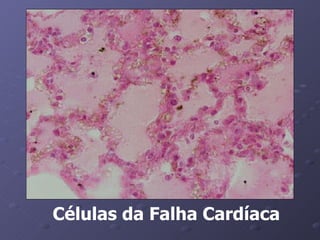 Células da Falha Cardíaca 