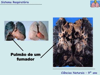 Sistema Respiratório




      Pulmão de um
         fumador


                       Ciências Naturais – 9º ano
 