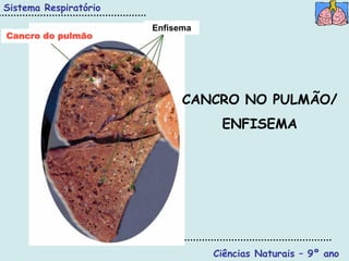 Sistema Respiratório

                       Enfisema
Cancro do pulmão




                             CANCRO NO PULMÃO/
                                   ENFISEMA




                                  Ciências Naturais – 9º ano
 