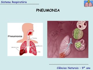 Sistema Respiratório


                       PNEUMONIA




                              Ciências Naturais – 9º ano
 