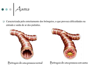 Asma

   Caracterizada pelo estreitamento dos brônquios, o que provoca dificuldades na
    entrada e saída de ar dos pulmões.




     Brônquio de uma pessoa normal            Brônquio de uma pessoa com asma
 