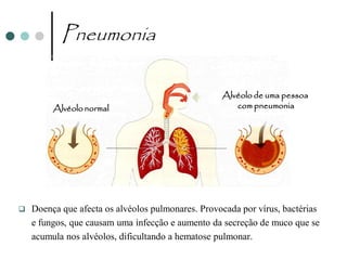 Pneumonia

                                                   Alvéolo de uma pessoa
         Alvéolo normal                               com pneumonia




   Doença que afecta os alvéolos pulmonares. Provocada por vírus, bactérias
    e fungos, que causam uma infecção e aumento da secreção de muco que se
    acumula nos alvéolos, dificultando a hematose pulmonar.
 