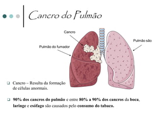 Cancro do Pulmão
                               Cancro

                                                                Pulmão são
                  Pulmão do fumador




   Cancro – Resulta da formação
    de células anormais.

   90% dos cancros do pulmão e entre 80% a 90% dos cancros da boca,
    laringe e esófago são causados pelo consumo do tabaco.
 