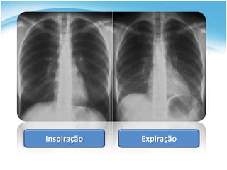 Inspiração   Expiração
 