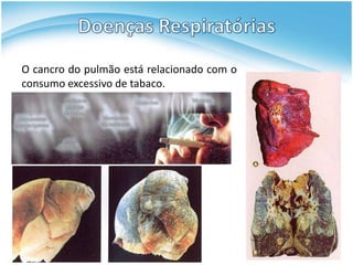 O cancro do pulmão está relacionado com o
consumo excessivo de tabaco.
 