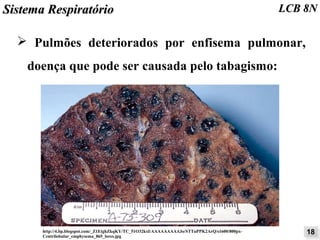 SSiisstteemmaa RReessppiirraattóórriioo LLCCBB 88NN 
➢ Pulmões deteriorados por enfisema pulmonar, 
doença que pode ser causada pelo tabagismo: 
http://4.bp.blogspot.com/_Z1EtghZkqKY/TC_51O32kxI/AAAAAAAAAJo/STTuPPK2ArQ/s1600/800px- 1188 
Centrilobular_emphysema_865_lores.jpg 
 