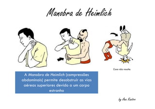Manobra de Heimlich
by Ana Kastro
A Manobra de Heimlich (compressões
abdominais) permite desobstruir as vias
aéreas superiores devido a um corpo
estranho
A Manobra de Heimlich (compressões
abdominais) permite desobstruir as vias
aéreas superiores devido a um corpo
estranho
Caso não resulte.
 