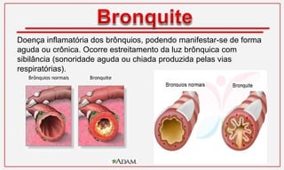 Doença inflamatória dos brônquios, podendo manifestar-se de forma
aguda ou crônica. Ocorre estreitamento da luz brônquica com
sibilância (sonoridade aguda ou chiada produzida pelas vias
respiratórias).
 