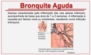 Doença caracterizada pela inflamação das vias aéreas inferiores,
acompanhada de tosse que dura de 1 a 3 semanas. A inflamação é
causada por fatores virais ou ambientais, resultando numa infecção
brônquica.
 