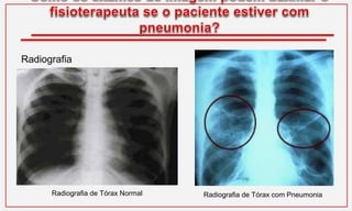 Radiografia
Radiografia de Tórax Normal Radiografia de Tórax com Pneumonia
 