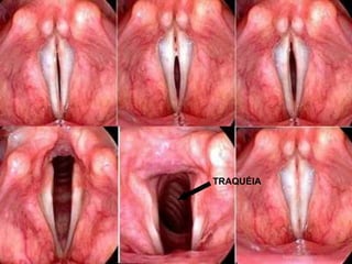 TRAQUÉIA
 