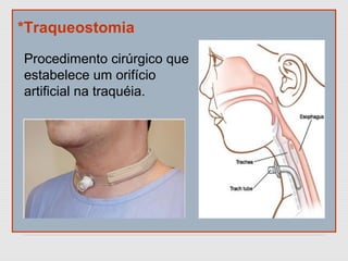 *Traqueostomia
Procedimento cirúrgico que
estabelece um orifício
artificial na traquéia.
 