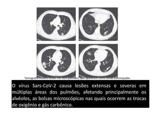 O vírus Sars-CoV-2 causa lesões extensas e severas em
múltiplas áreas dos pulmões, afetando principalmente os
alvéolos, as bolsas microscópicas nas quais ocorrem as trocas
de oxigênio e gás carbônico.
Tomografia mostra lesões nos dois pulmões, que aparecem como zonas esfumaçadas
 