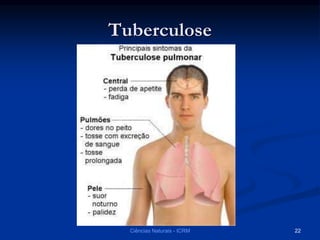 Tuberculose
Ciências Naturais - ICRM 22
 