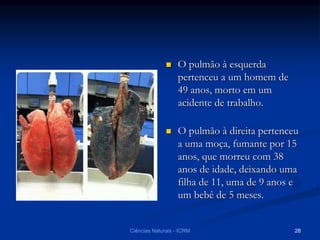 O pulmão à esquerda
pertenceu a um homem de
49 anos, morto em um
acidente de trabalho.
 O pulmão à direita pertenceu
a uma moça, fumante por 15
anos, que morreu com 38
anos de idade, deixando uma
filha de 11, uma de 9 anos e
um bebê de 5 meses.
Ciências Naturais - ICRM 28
 