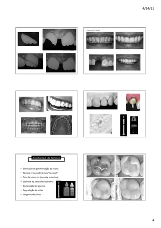 4/24/11	
  
4	
  
Baratieri (2000)!
Conceição (2000)!
Limitações da técnica!
•  Contração	
  de	
  polimerização	
  da	
  resina	
  
•  Técnica	
  restauradora	
  mais	
  “sensível”	
  
•  Tipo	
  de	
  substrato	
  (esmalte	
  ×	
  den8na)	
  
•  Controle	
  da	
  umidade	
  da	
  den8na	
  
•  Composição	
  do	
  adesivo	
  
•  Degradação	
  da	
  união	
  	
  
•  Longevidade	
  clínica	
  
 