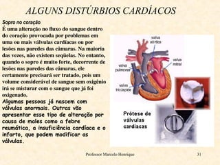 Professor Marcelo Henrique 31
ALGUNS DISTÚRBIOS CARDÍACOS
Sopro no coração
É uma alteração no fluxo do sangue dentro
do coração provocada por problemas em
uma ou mais válvulas cardíacas ou por
lesões nas paredes das câmaras. Na maioria
das vezes, não existem seqüelas. No entanto,
quando o sopro é muito forte, decorrente de
lesões nas paredes das câmaras, ele
certamente precisará ser tratado, pois um
volume considerável de sangue sem oxigênio
irá se misturar com o sangue que já foi
oxigenado.
Algumas pessoas já nascem com
válvulas anormais. Outras vão
apresentar esse tipo de alteração por
causa de males como a febre
reumática, a insuficiência cardíaca e o
infarto, que podem modificar as
válvulas.
 