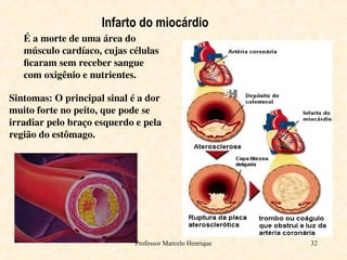 Professor Marcelo Henrique 32
Infarto do miocárdio
É a morte de uma área do
músculo cardíaco, cujas células
ficaram sem receber sangue
com oxigênio e nutrientes.
Sintomas: O principal sinal é a dor
muito forte no peito, que pode se
irradiar pelo braço esquerdo e pela
região do estômago.
 