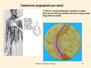 Professor Marcelo Henrique 34
Cateterismo (angioplastia por stent):
1- Para ver o local da obstrução, é inserido um cateter
(tubo com um visor) que identifica até onde o sangue ainda
chega dentro da artéria.
 