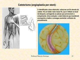 Professor Marcelo Henrique 35
Cateterismo (angioplastia por stent):
2- Identificada a área obstruída, coloca-se um fio através do
cateter. Há um balão vazio nesse fio, que é inflado no local
de bloqueio, esmagando as placas que provocaram o
entupimento. Uma evolução: o stent (tela de aço inoxidável)
acompanha o balão e consegue aumentar a eficácia do
procedimento
 