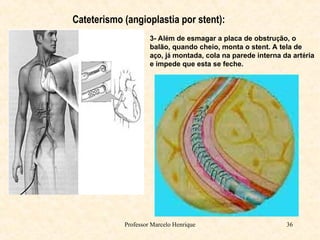 Professor Marcelo Henrique 36
Cateterismo (angioplastia por stent):
3- Além de esmagar a placa de obstrução, o
balão, quando cheio, monta o stent. A tela de
aço, já montada, cola na parede interna da artéria
e impede que esta se feche.
 