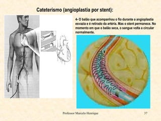 Professor Marcelo Henrique 37
Cateterismo (angioplastia por stent):
4- O balão que acompanhou o fio durante a angioplastia
esvazia e é retirado da artéria. Mas o stent permanece. No
momento em que o balão seca, o sangue volta a circular
normalmente.
 