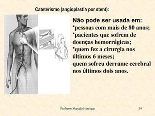 Professor Marcelo Henrique 39
Cateterismo (angioplastia por stent):
Não pode ser usada em:
•pessoas com mais de 80 anos;
•pacientes que sofrem de
doenças hemorrágicas;
•quem fez a cirurgia nos
últimos 6 meses;
quem sofreu derrame cerebral
nos últimos dois anos.
 