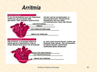Professor Marcelo Henrique 40
Arritmia
 