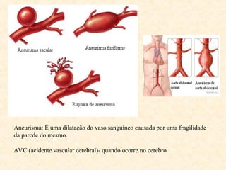 Aneurisma: É uma dilatação do vaso sanguíneo causada por uma fragilidade
da parede do mesmo.
AVC (acidente vascular cerebral)- quando ocorre no cerebro
 