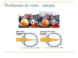 Problemas de visão - miopia
 