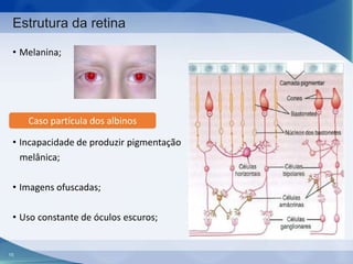 Estrutura da retina
• Melanina;

Caso partícula dos albinos
• Incapacidade de produzir pigmentação
melânica;

• Imagens ofuscadas;
• Uso constante de óculos escuros;

15

 