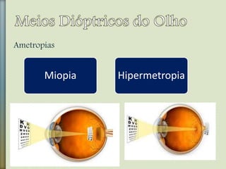 Ametropias
Miopia Hipermetropia
 