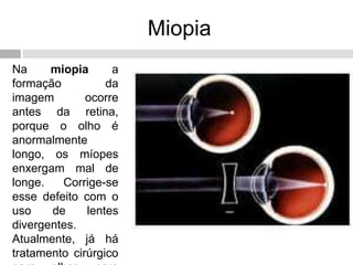 Miopia
Na miopia a
formação da
imagem ocorre
antes da retina,
porque o olho é
anormalmente
longo, os míopes
enxergam mal de
longe. Corrige-se
esse defeito com o
uso de lentes
divergentes.
Atualmente, já há
tratamento cirúrgico
 