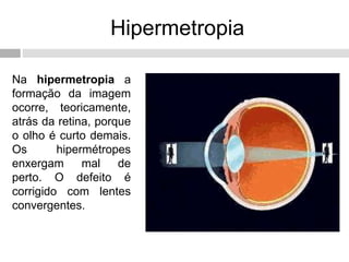 Hipermetropia
Na hipermetropia a
formação da imagem
ocorre, teoricamente,
atrás da retina, porque
o olho é curto demais.
Os hipermétropes
enxergam mal de
perto. O defeito é
corrigido com lentes
convergentes.
 