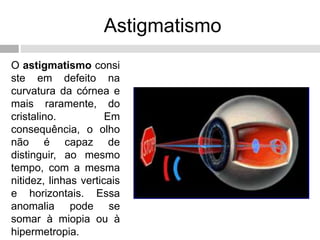 Astigmatismo
O astigmatismo consi
ste em defeito na
curvatura da córnea e
mais raramente, do
cristalino. Em
consequência, o olho
não é capaz de
distinguir, ao mesmo
tempo, com a mesma
nitidez, linhas verticais
e horizontais. Essa
anomalia pode se
somar à miopia ou à
hipermetropia.
 