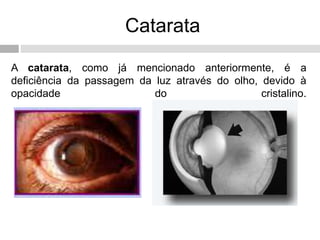 Catarata
A catarata, como já mencionado anteriormente, é a
deficiência da passagem da luz através do olho, devido à
opacidade do cristalino.
 